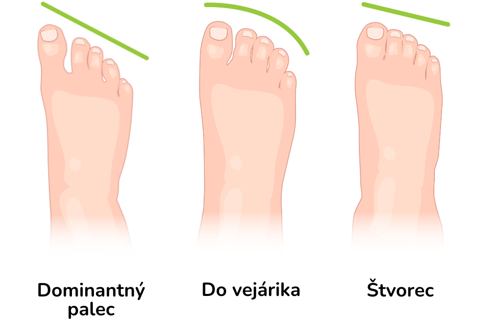 SK  Typy chodidel - palce